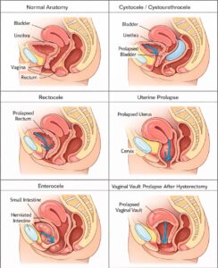 Medical diagram comparing normal female pelvic anatomy to various types of pelvic organ prolapse, including cystocele, rectocele, uterine prolapse, enterocele, and vaginal vault prolapse.